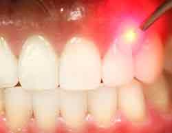 لیزر در دندانپزشکی-دکترمجیدقیاسی بهترین دندانپزشک زیبایی درمشهد