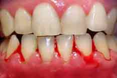 التهاب لثه-دکترمجیدقیاسی بهترین دندانپزشک زیبایی درمشهد-جراحی لثه درمشهد